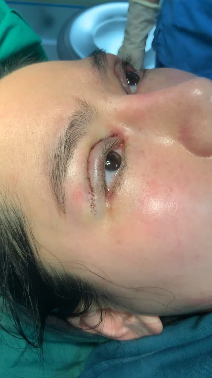 Cắt mí trên chỉnh sẹo góc mắt trong với Dr Vương !