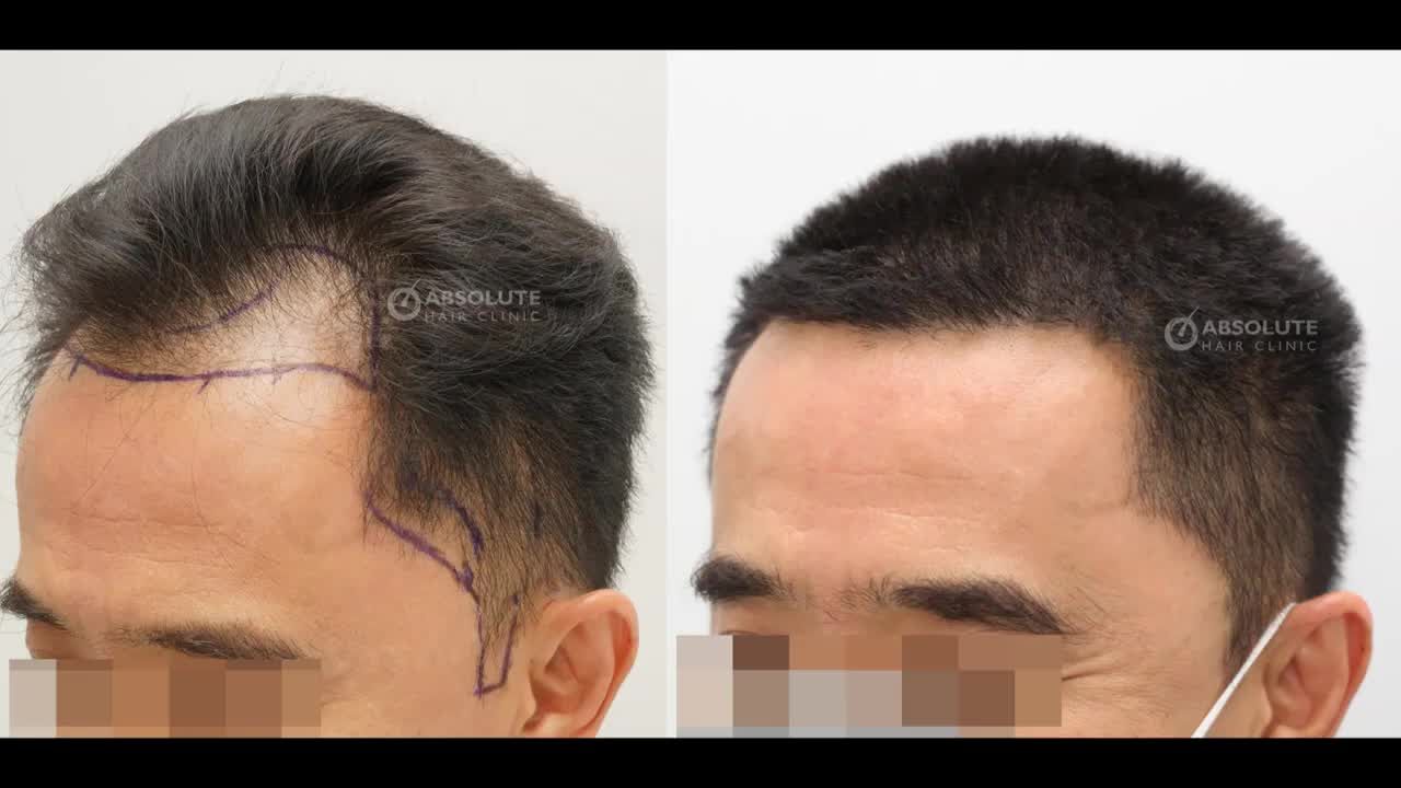 Cấy tóc tự thân 2540 nang tóc kỹ thuật FUE, kết quả sau 7 tháng