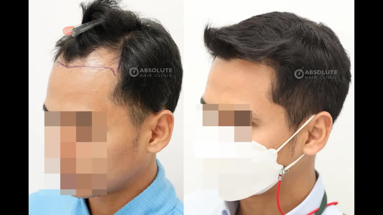 Kết quả cấy tóc FUE 2350 nang sau 7 tháng