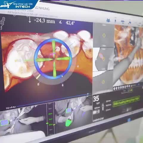 NHA KHOA LẠC VIỆT INTECH - ỨNG DỤNG CÔNG NGHỆ THỰC TẾ ẢO TRONG TRỒNG RĂNG IMPLANT