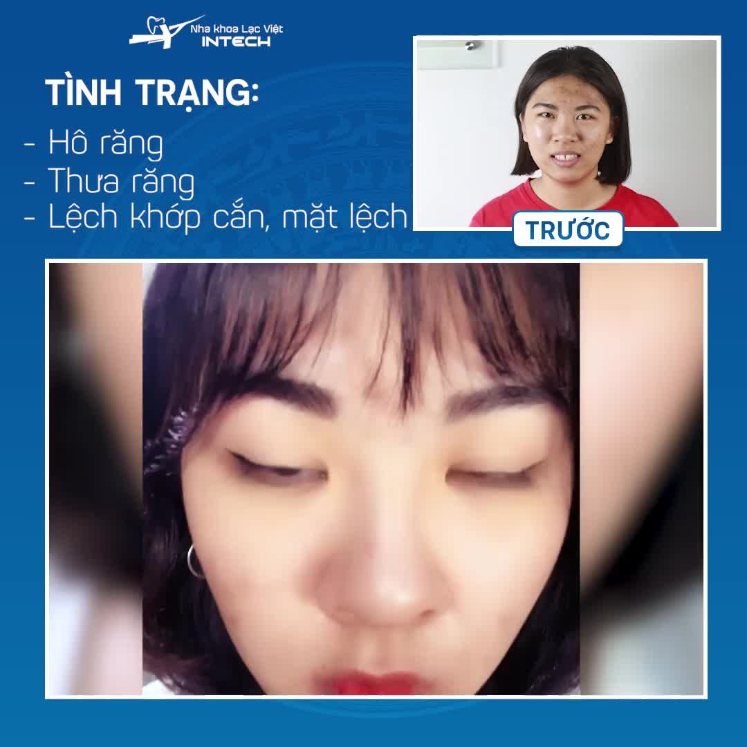 NIỀNG RĂNG HÔ, THƯA: RĂNG ĐẸP CƯỜI XINH, TỰ TIN GIAO TIẾP
