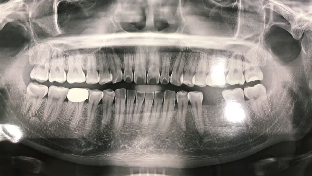 Ca cấy ghép chân răng nhân tạo Implant cho khách hàng bị mất răng số 36