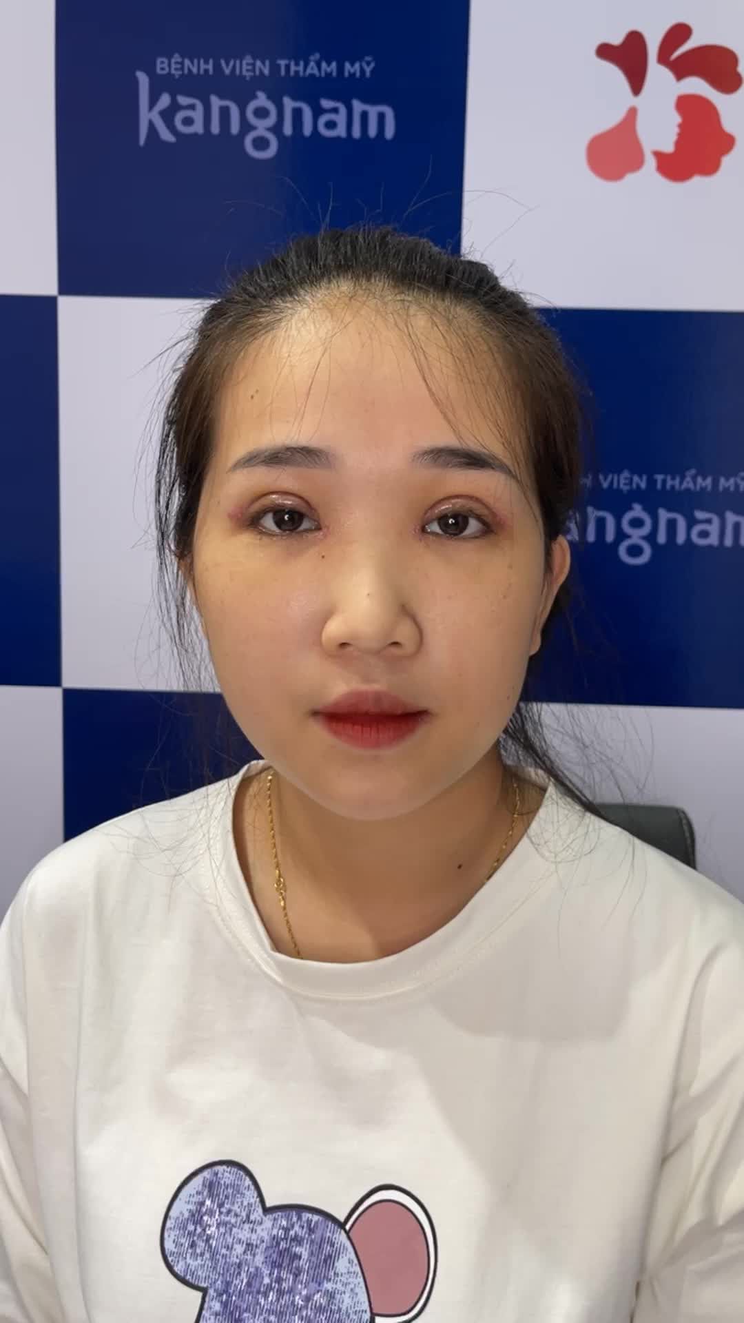 10 ngày sau cắt mí - Đường mí đẹp như vẽ!