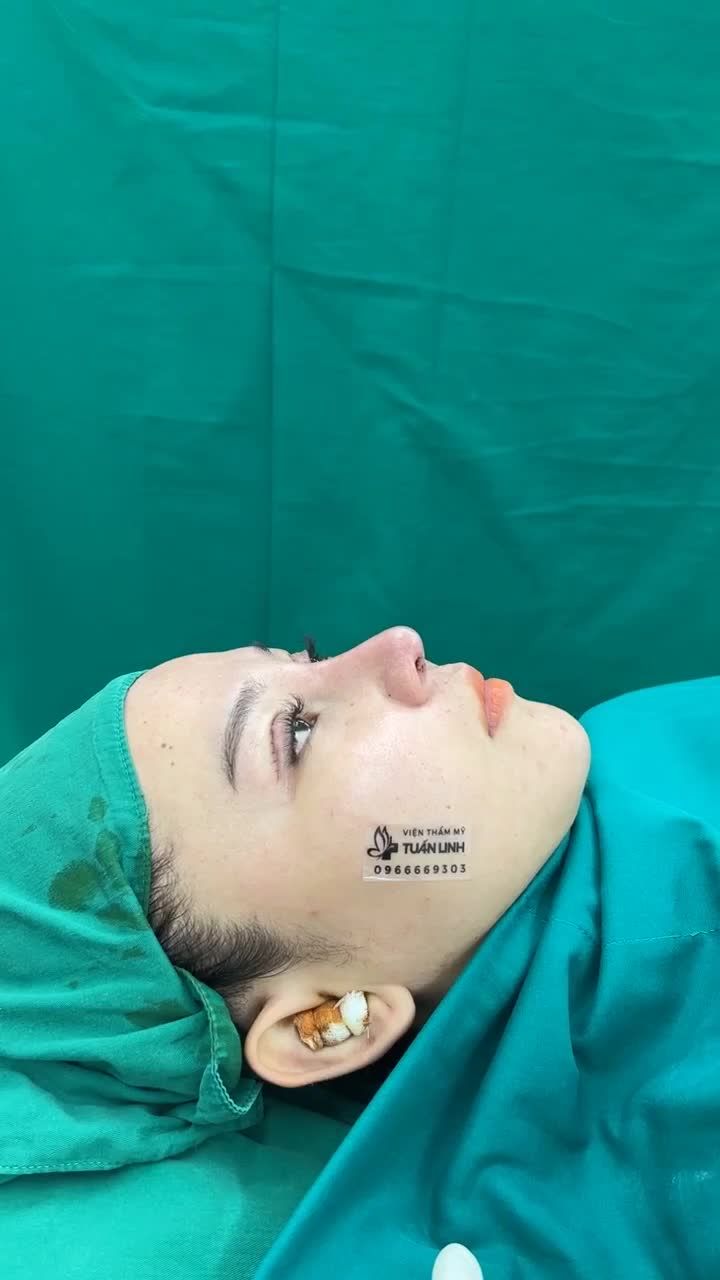 8h tối và ekip Tuấn Linh vừa hoàn thành một case Nâng mũi Siêu cấu trúc sửa lại + cắt mí cho bạn gái đến từ Cà Mau