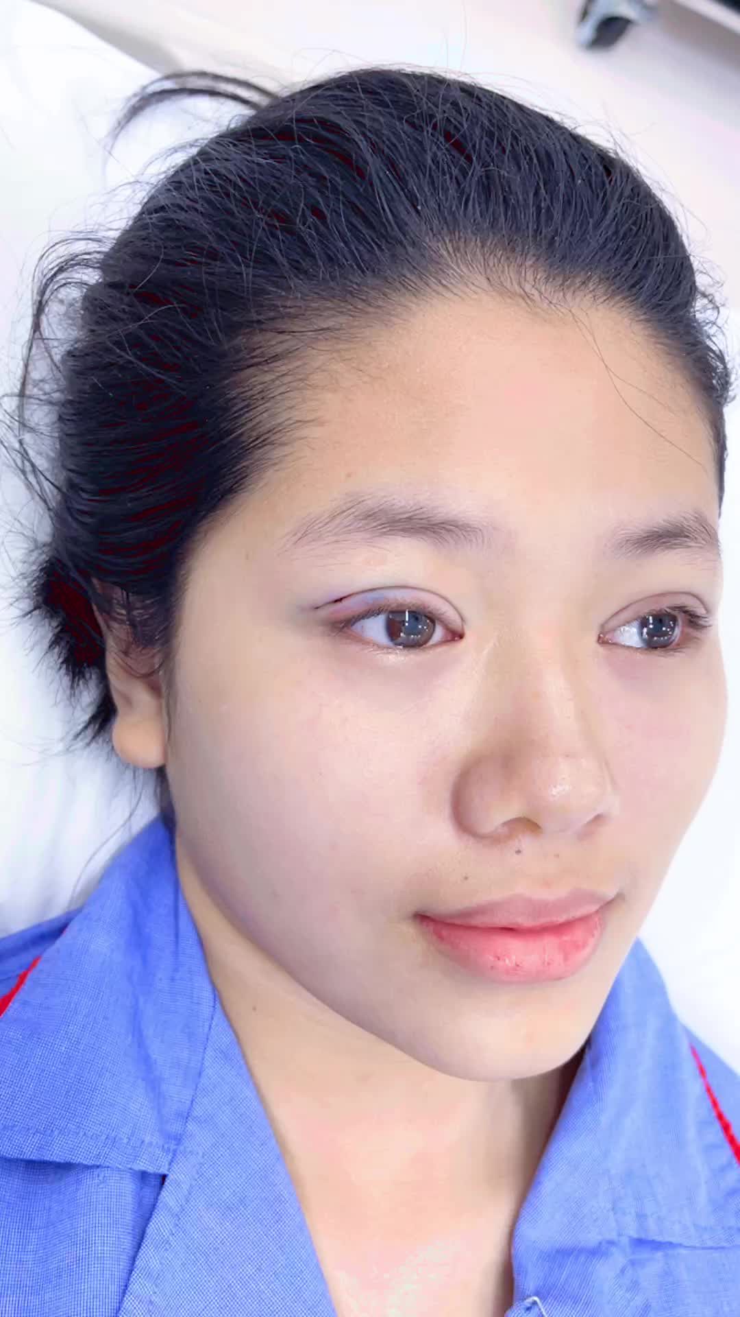 Bấm mí - Phương pháp dành cho các bạn trẻ muốn có nếp mí to, tự nhiên