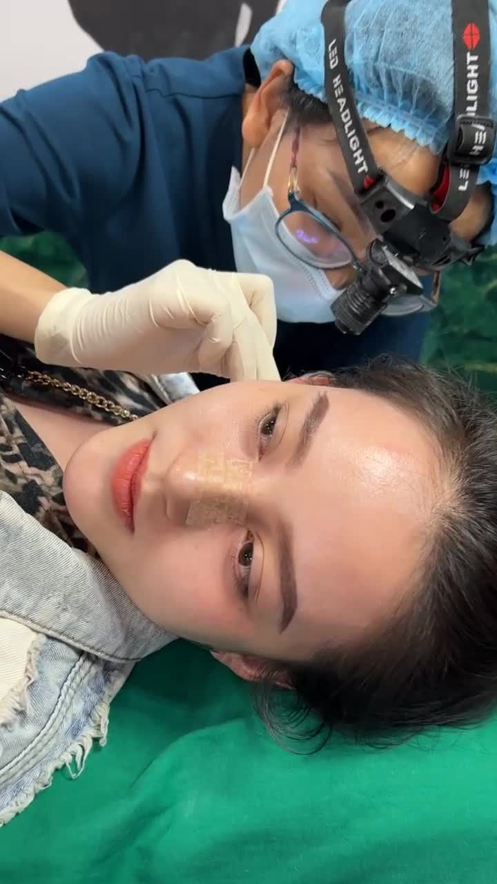 Case Nâng mũi Siêu cấu trúc surgiform được 10 ngày cho bé khách xinh như “búp bê”
