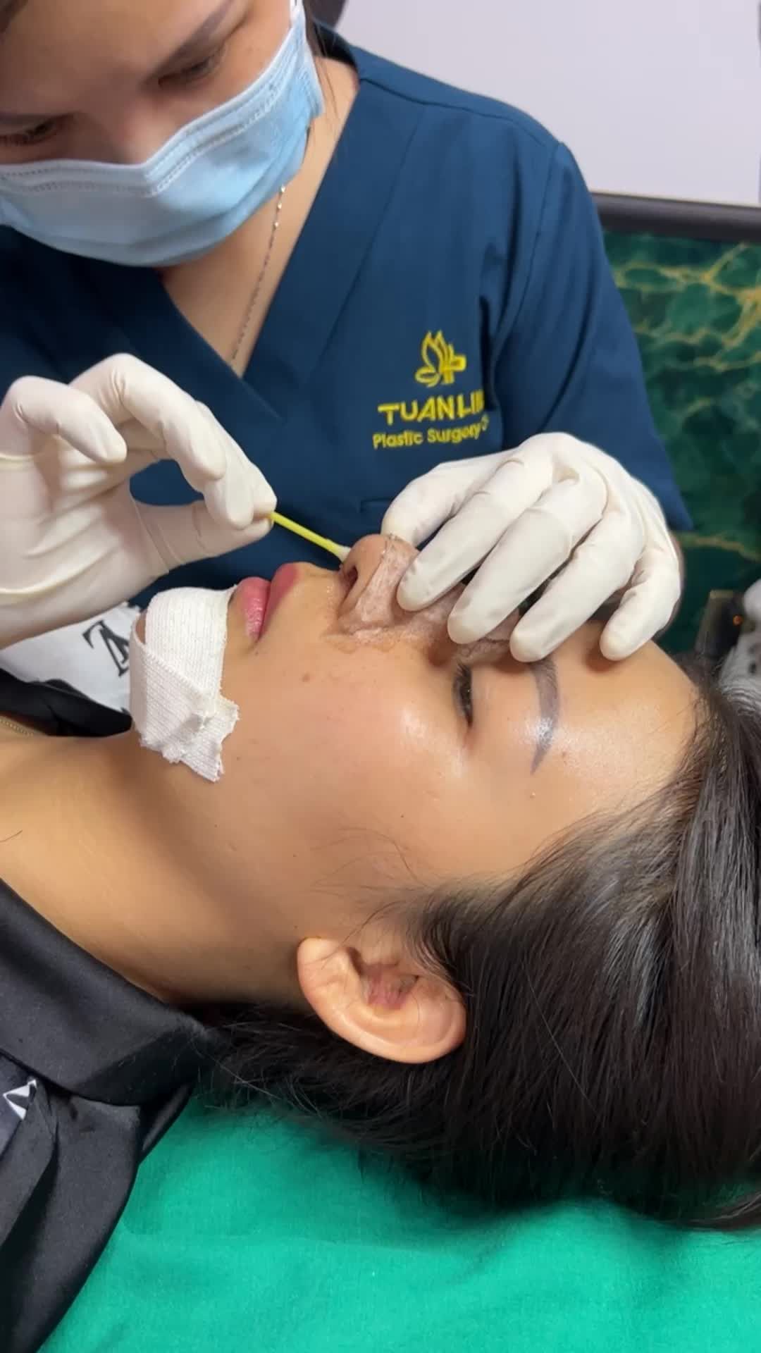 Case nâng mũi tái cấu trúc phức tạp + Độn cằm Plasma sau 5 ngày thay nẹp.