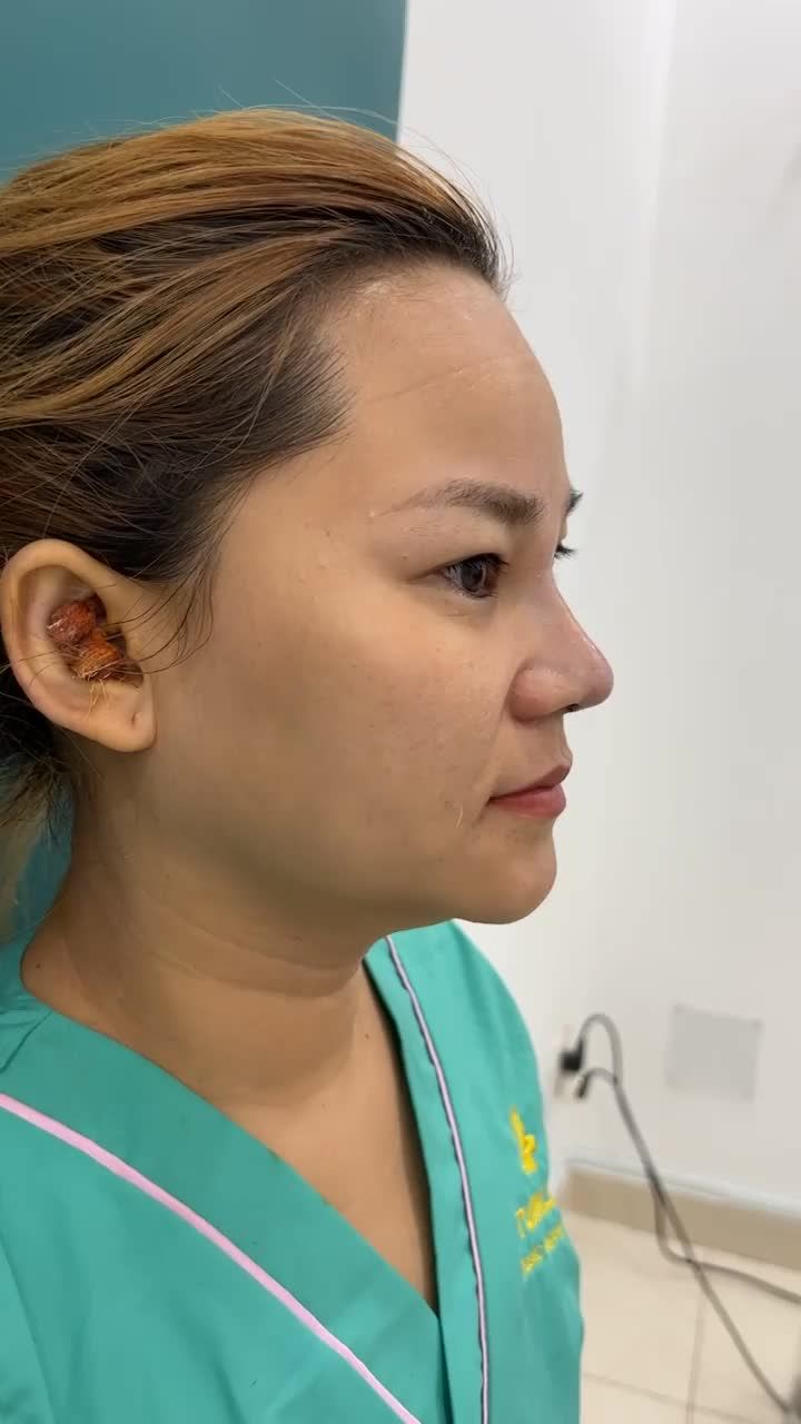 Bạn gái đến từ Bình Dương được bạn bè giới thiệu qua viện để nâng mũi.