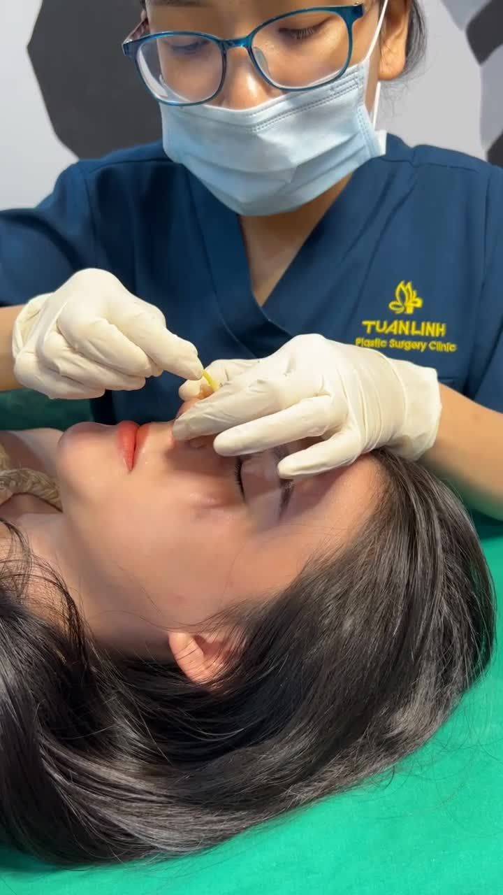 Case mũi Siêu cấu trúc sụn surgiform được 5 ngày - khách hàng đến Viện thay nẹp