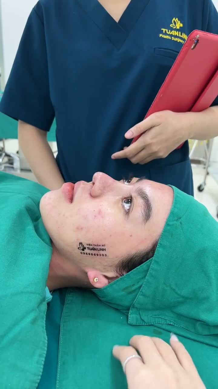Case mũi Siêu cấu trúc tặng sụn Surgiform vừa hoàn thành tại Viện