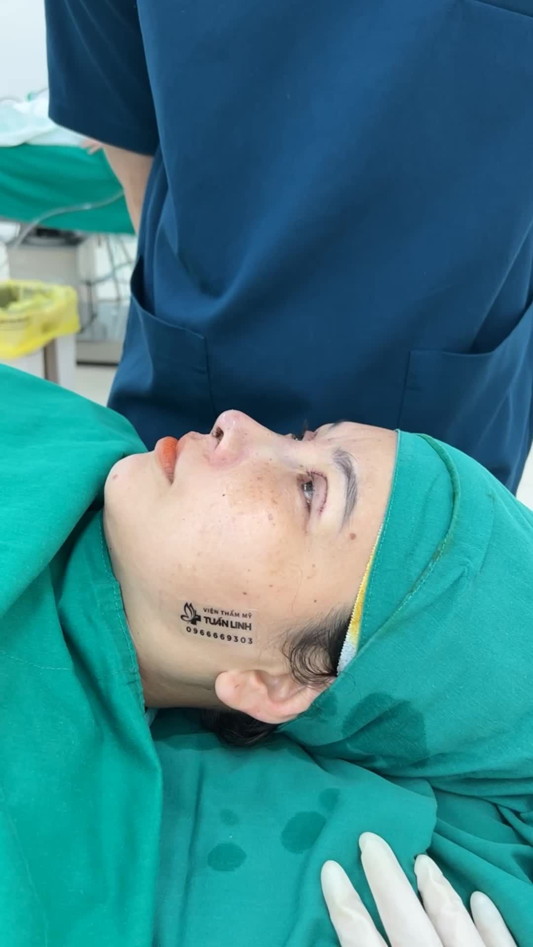 Case Nâng mũi siêu cấu trúc sụn Surgiform + Cắt mí vừa hoàn thành sau 120 phút.
