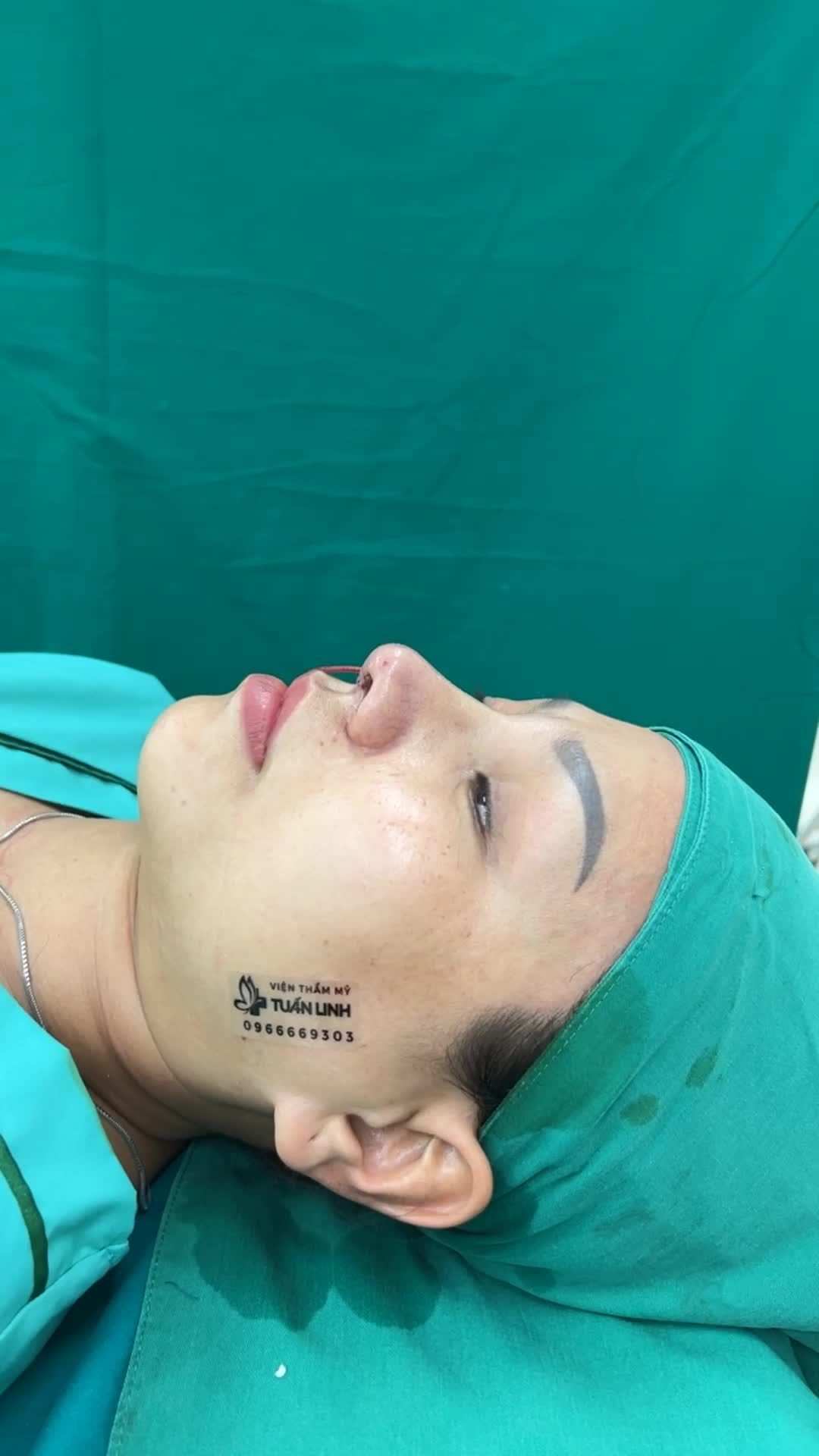 Case Nâng mũi Siêu cấu trúc sụn surgiform vừa hoàn thành sau 90 phút!