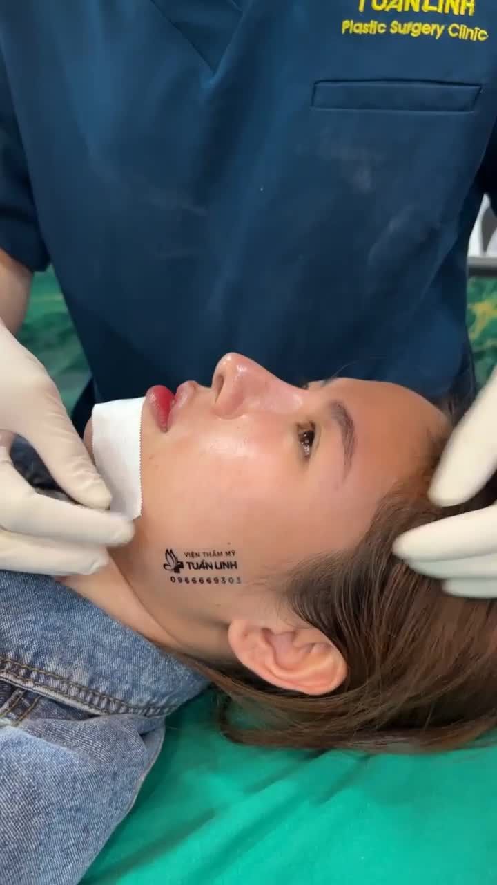 Case độn cằm được 7 ngày - khách hàng đến Viện để tháo nẹp và tái khám