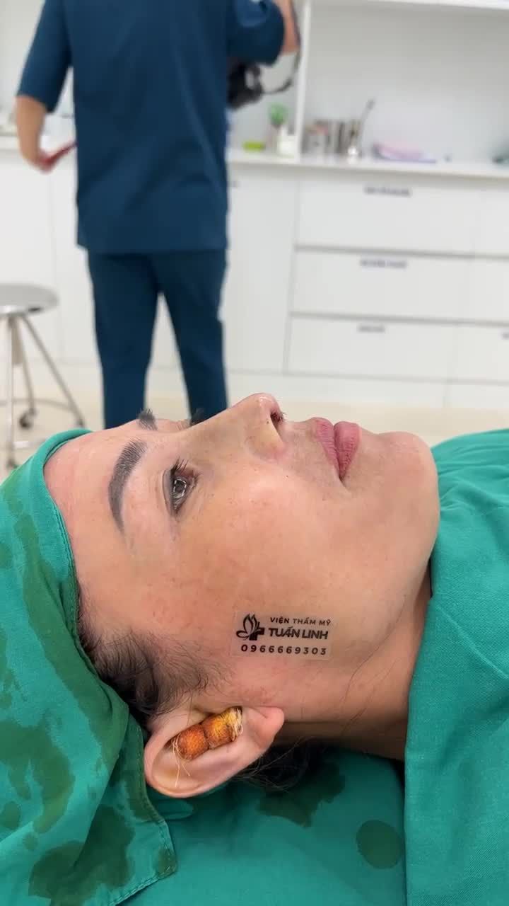 Case Nâng mũi cấu trúc bọc megaderm toàn sóng vừa thực hiện xong tại Tuấn Linh.