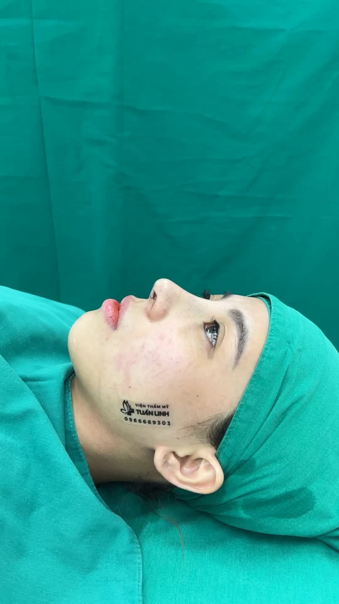 Đầu mũi cao bay, sống mũi lượn tự nhiên sau 90 phút nâng mũi Siêu cấu trúc tại Tuấn Linh.