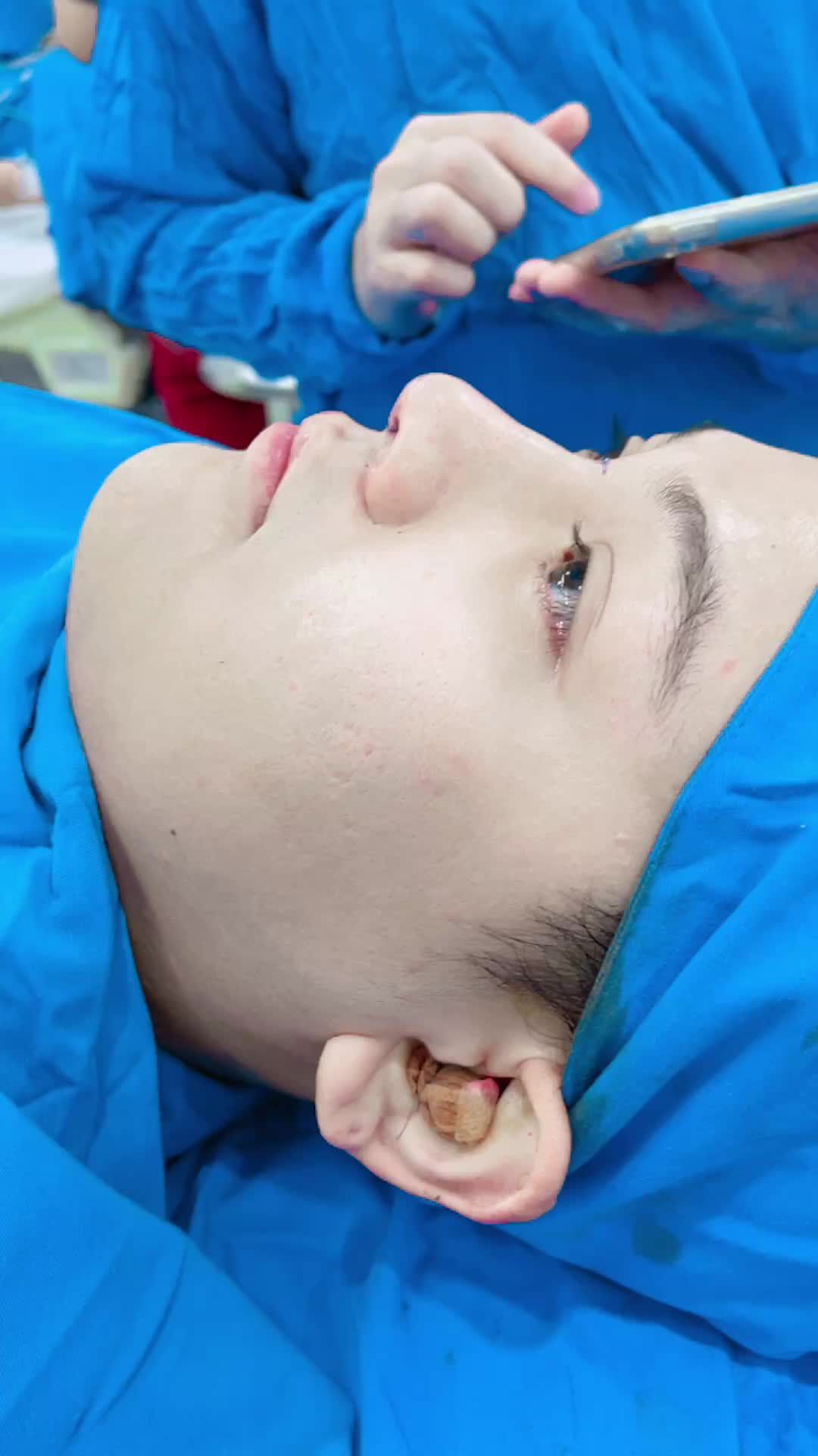 Khách hàng nam vừa nâng mũi cấu trúc 4D xong đây ạ!