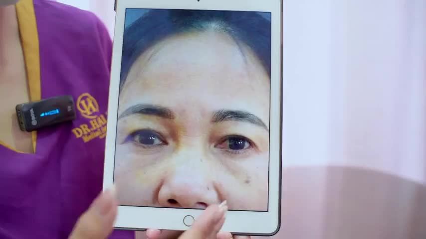 Mắt sụp mí tuổi trung niên được Bác sĩ xử lý như thế nào Theo dõi ngay tại video này bạn nhé