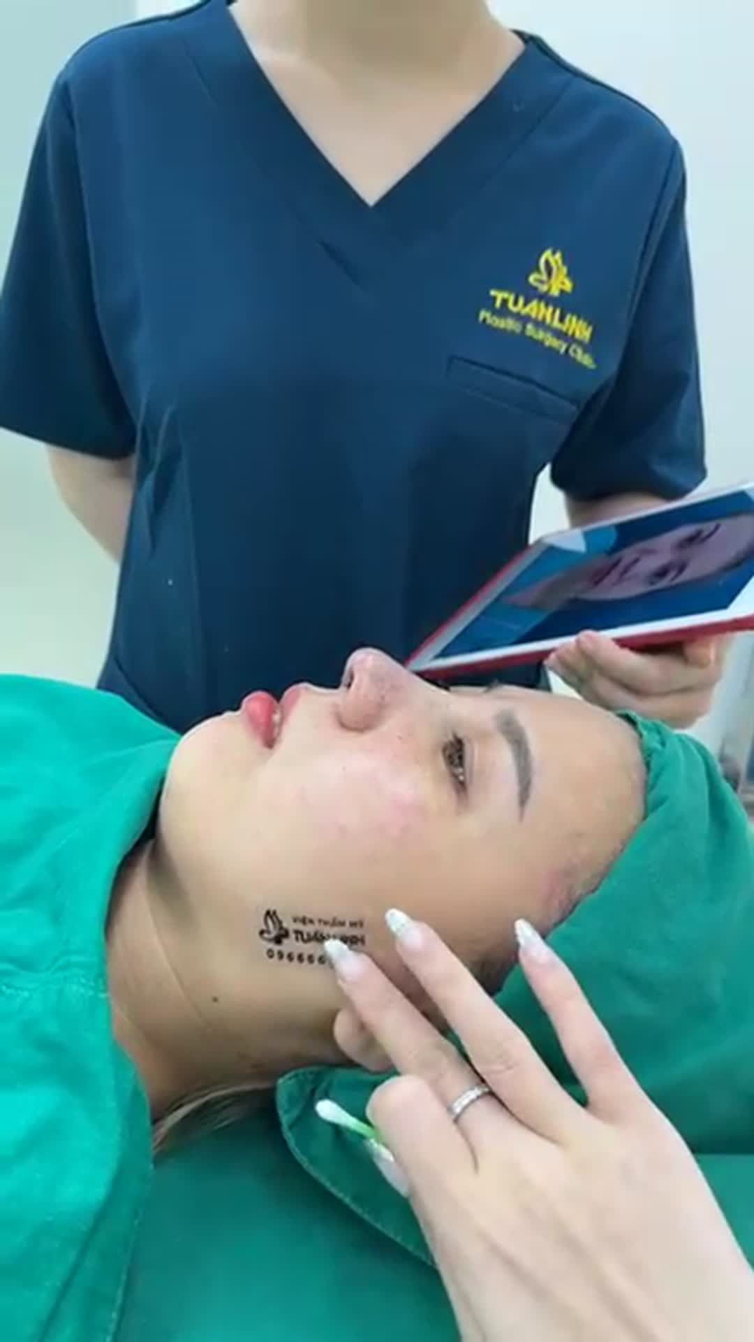 Tiếp tục một case Nâng mũi siêu cấu trúc #Surgiform vừa hoàn thành tại viện!!!