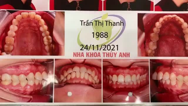 Cắm 2 minivis hỗ trợ kéo lùi hàm giảm hô cho chị Thanh - bệnh nhân chỉnh nha tại Nha Khoa Thuỳ Anh