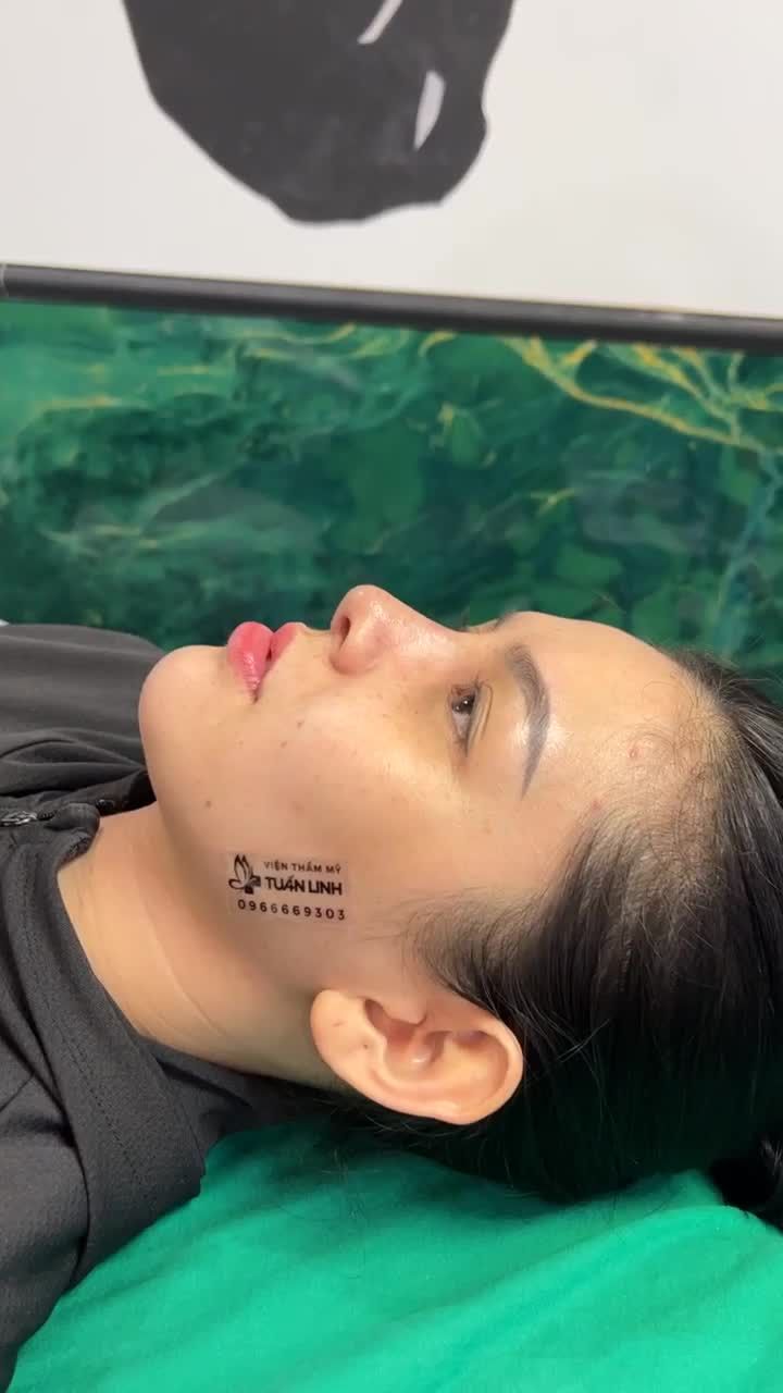 Case Nâng mũi Siêu cấu trúc sụn surgiform sau 10 ngày tháo nẹp