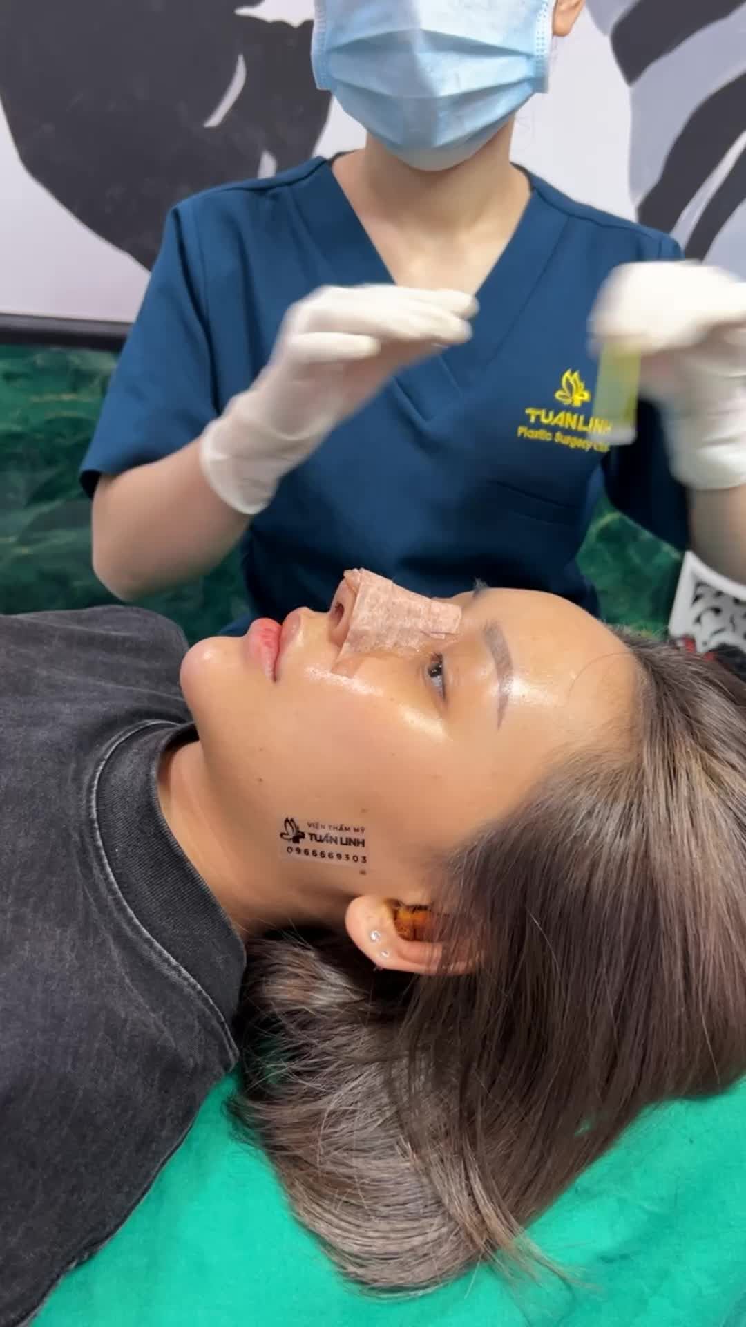Case Nâng mũi siêu cấu trúc Surgiform sụn sườn tự thân được 5 ngày