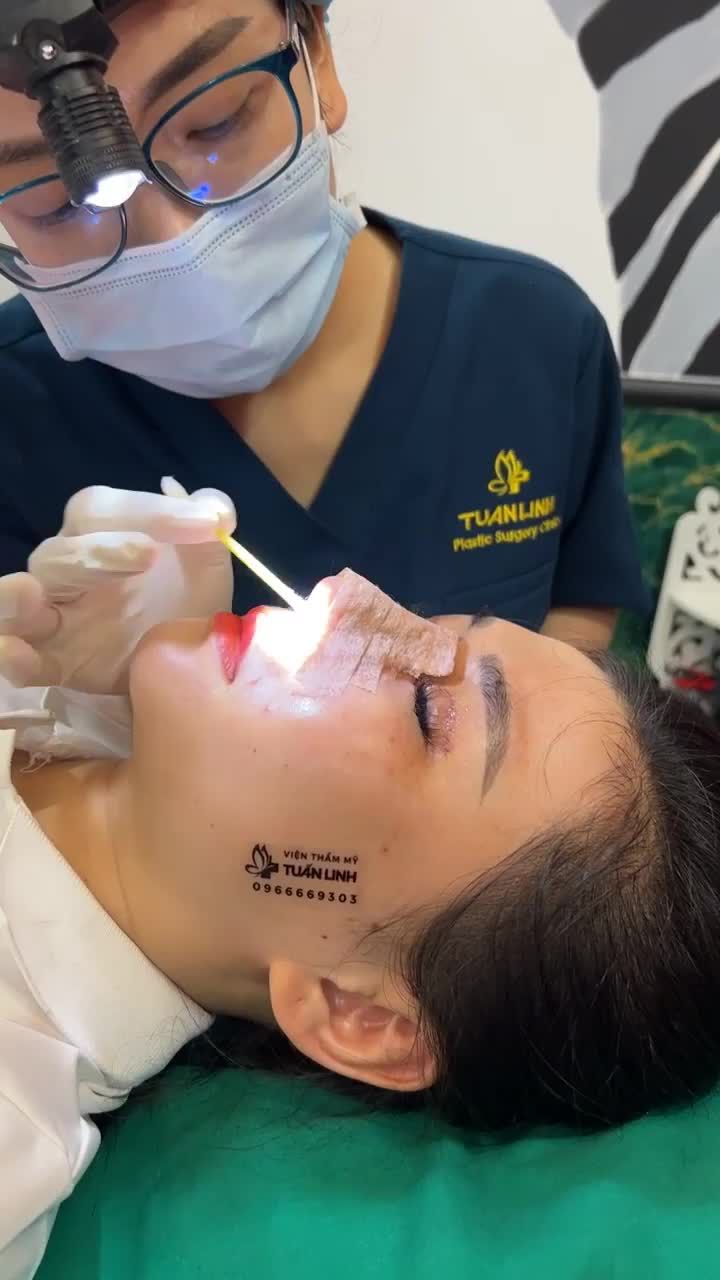 Case Siêu cấu trúc sụn surgiform + cắt mí + mở góc mắt được 5 ngày