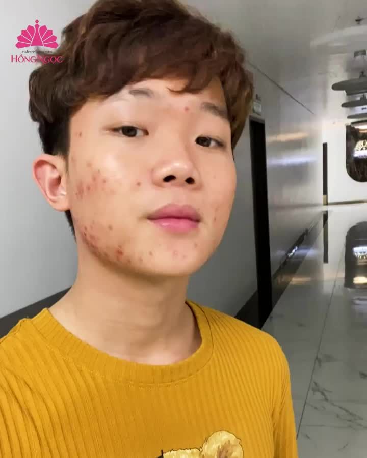 GENZ TRẢI NGHIỆM CN TRỊ MỤN HÀNG ĐẦU TẠI HỒNG NGỌC