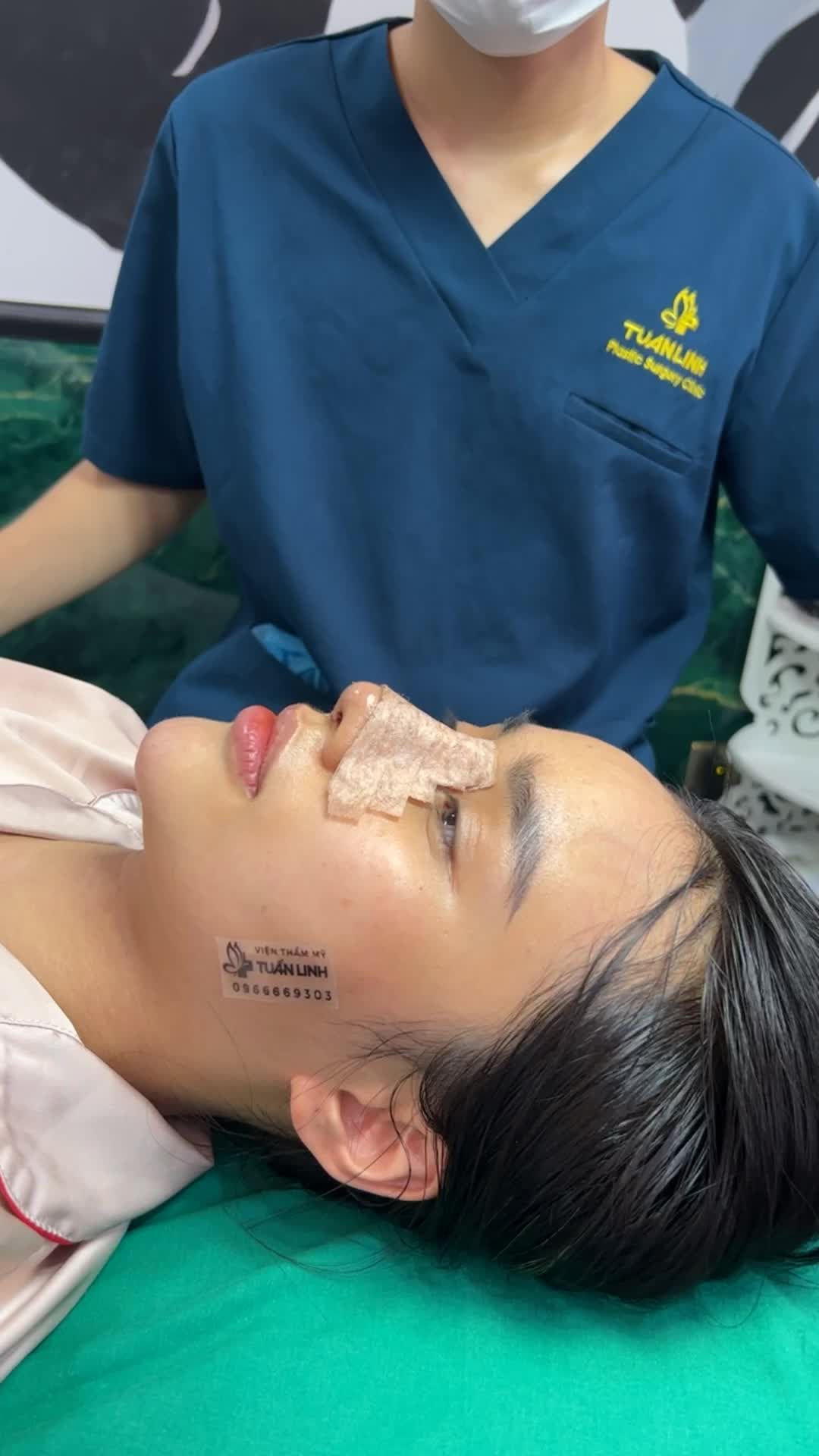 Khách hàng nâng mũi Siêu cấu trúc surgiform thay nẹp sau 5 ngày.