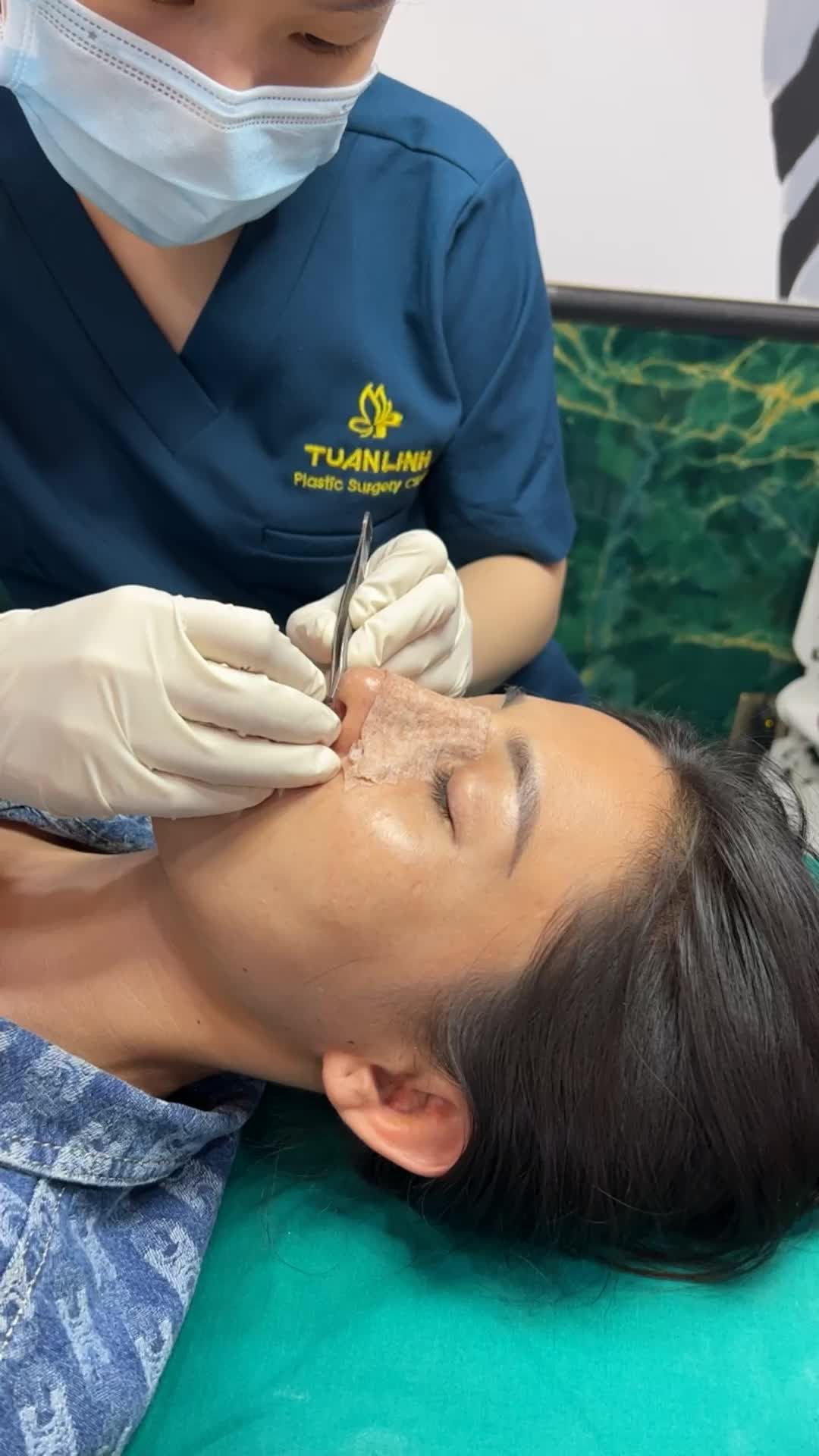 Nâng mũi cấu trúc Surgiform sau 10 ngày sẽ lên dáng như thế nào