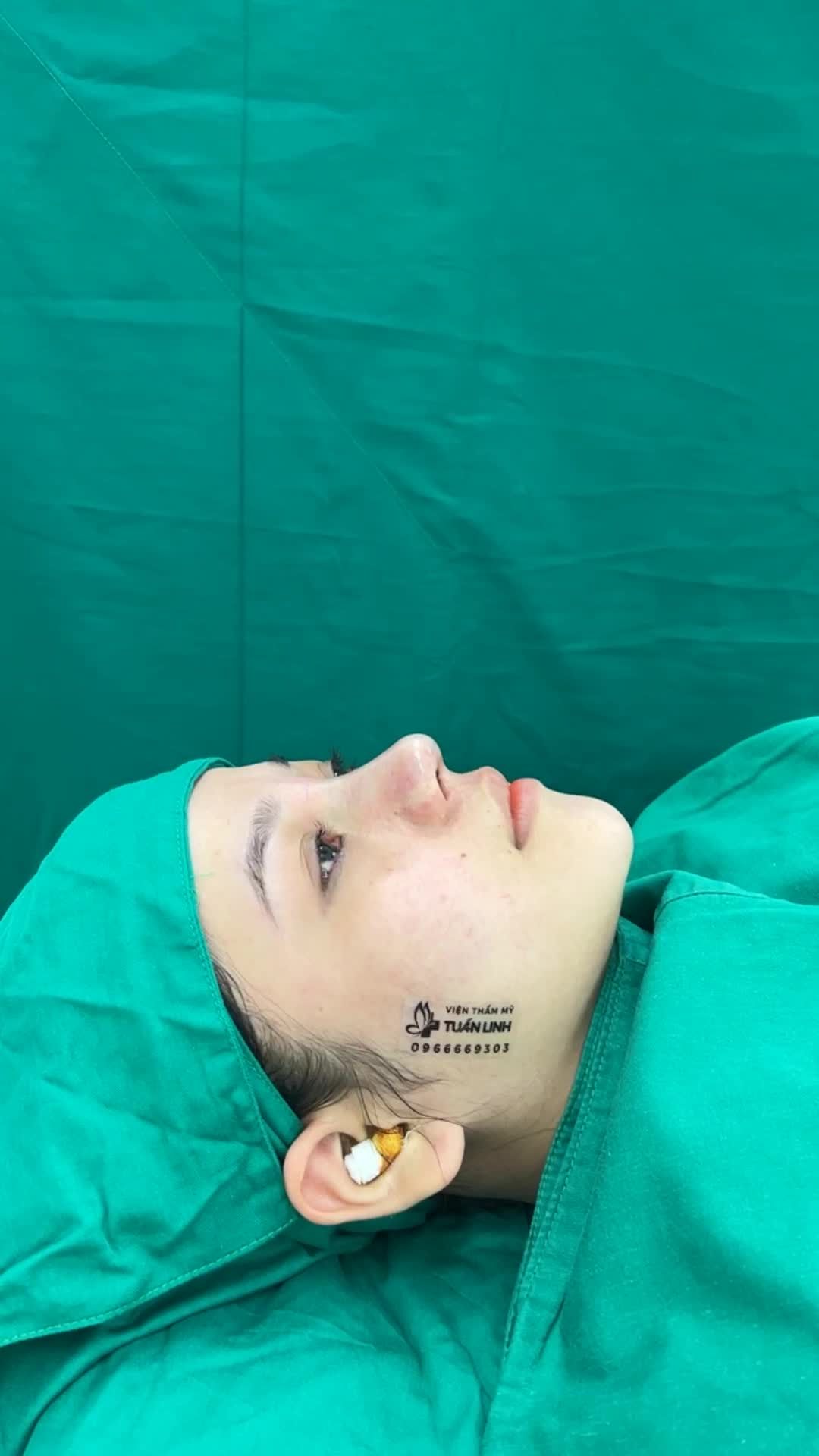 Case mũi bọc sụn đẹp tựa cấu trúc cho bạn gái có nền tảng sẵn