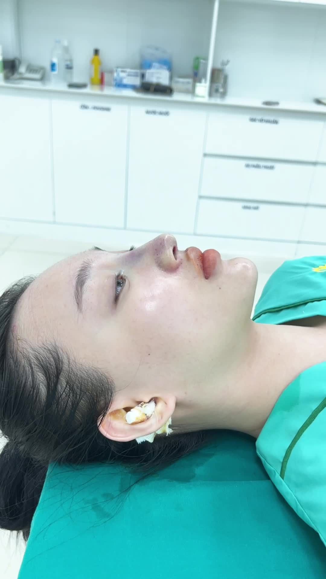 Case nâng mũi bọc sụn vừa hoàn thành sau 60 phút tại Tuấn Linh.