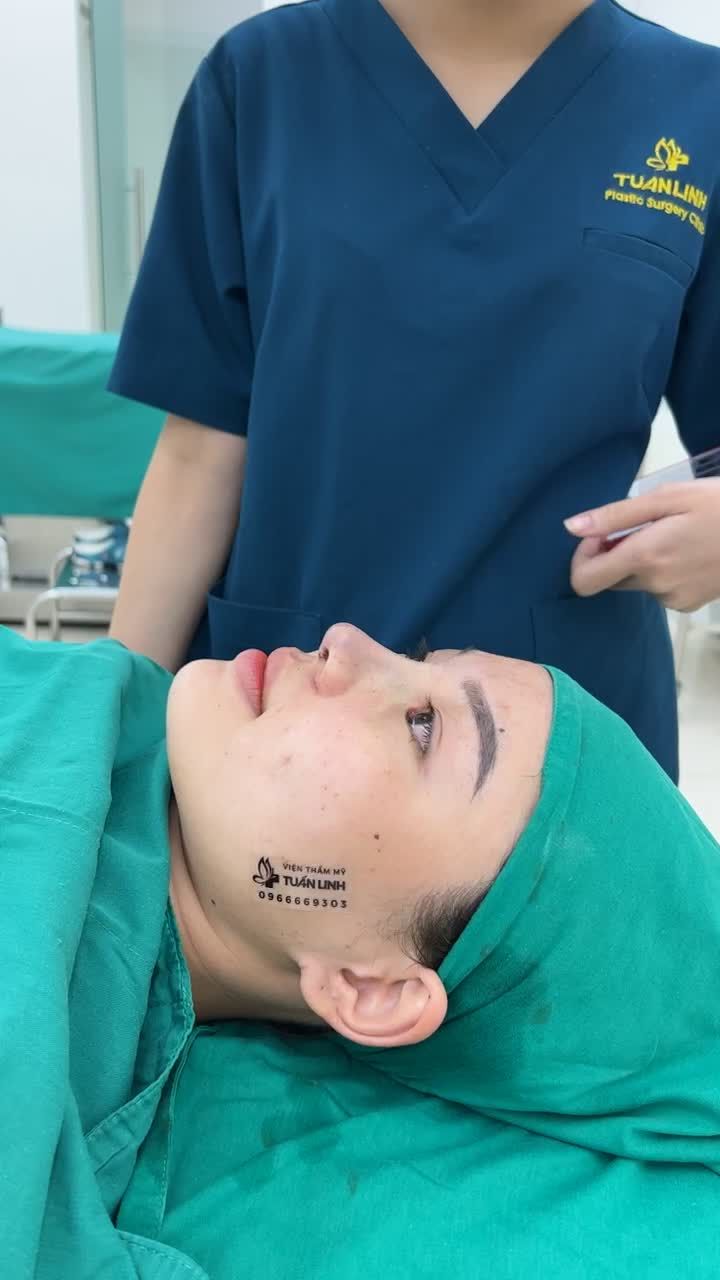 Case Nâng mũi Siêu cấu trúc (tặng sụn Surgiform) cho khách hàng đến từ Đồng Nai !!!