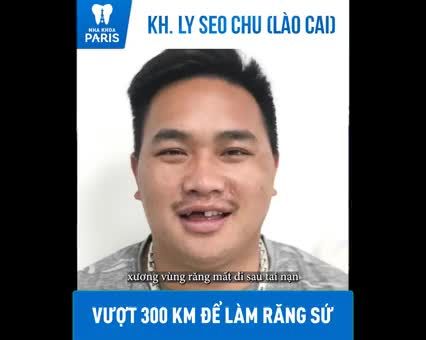 Chị gái làm răng xong đẹp quá, em rủ thêm cả thằng bạn xuống Paris Hà Nội để làm luôn