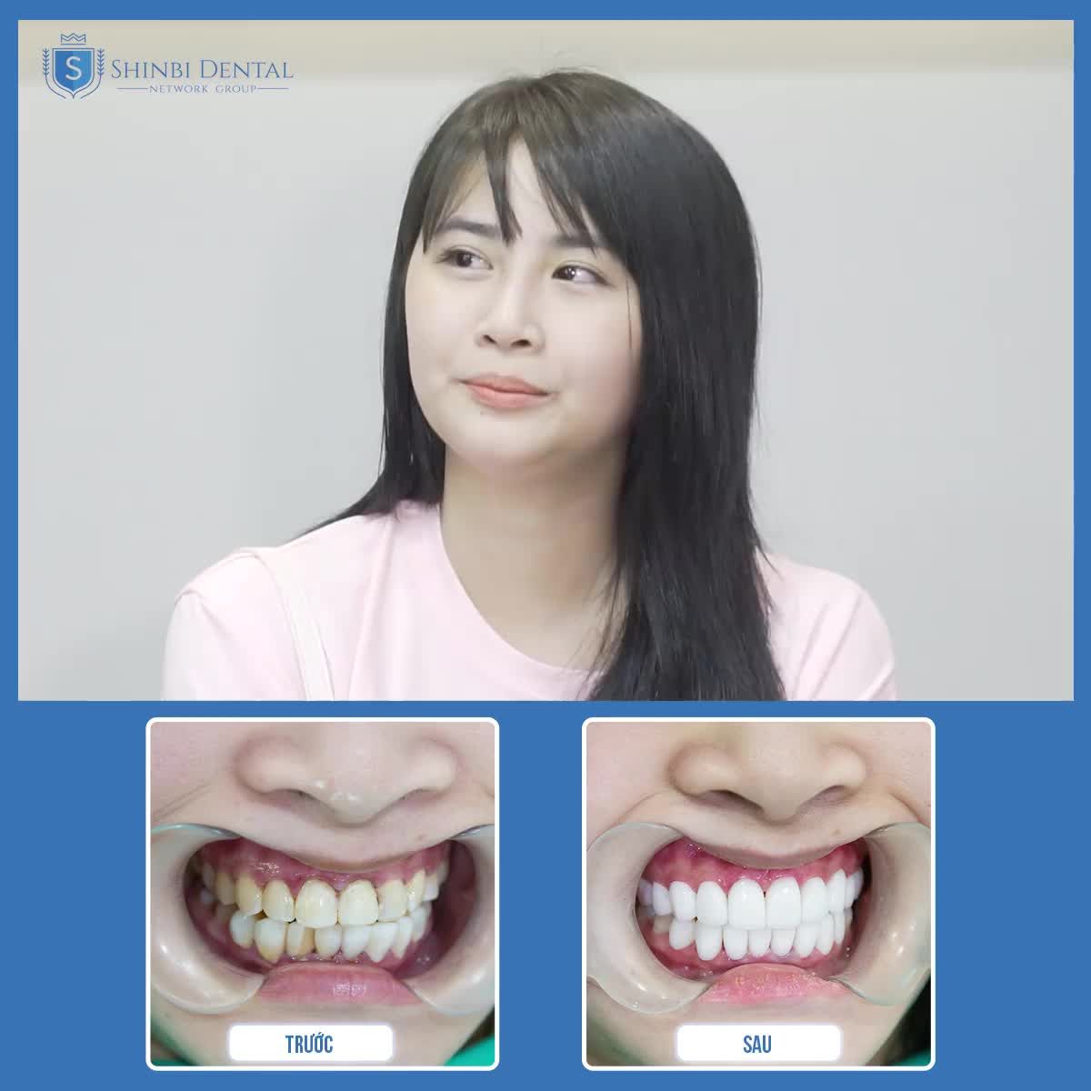 Đến những thời điểm, chúng ta cần phải quan tâm nhiều hơn đến nụ cười của mình, đó không chỉ là thẩm mỹ mà còn là vấn đề sức khỏe.