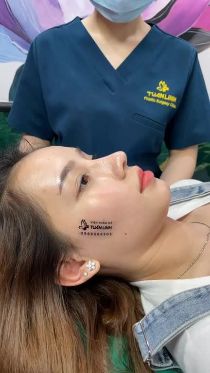 Khách hàng sau nâng mũi tái cấu trúc được  4 tháng