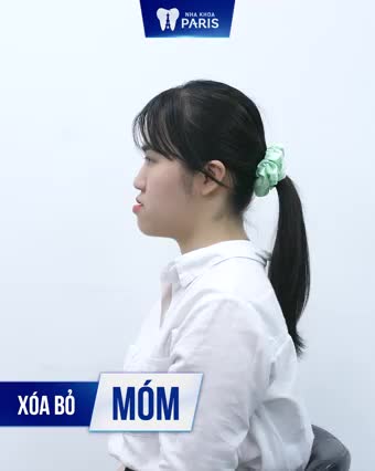 Phẫu thuật hàm hô, móm hàng đầu Hà Nội