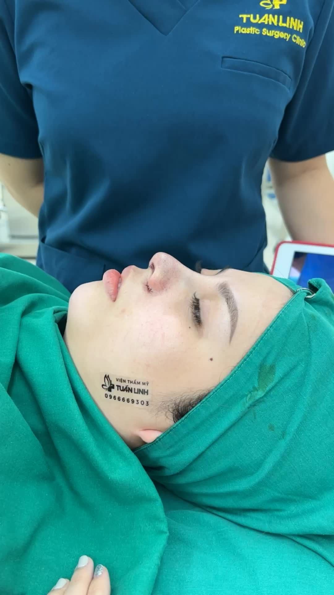 Mũi đẹp ngay sau 90 phút - Không đau - Không sưng- Không cần nghỉ dưỡng