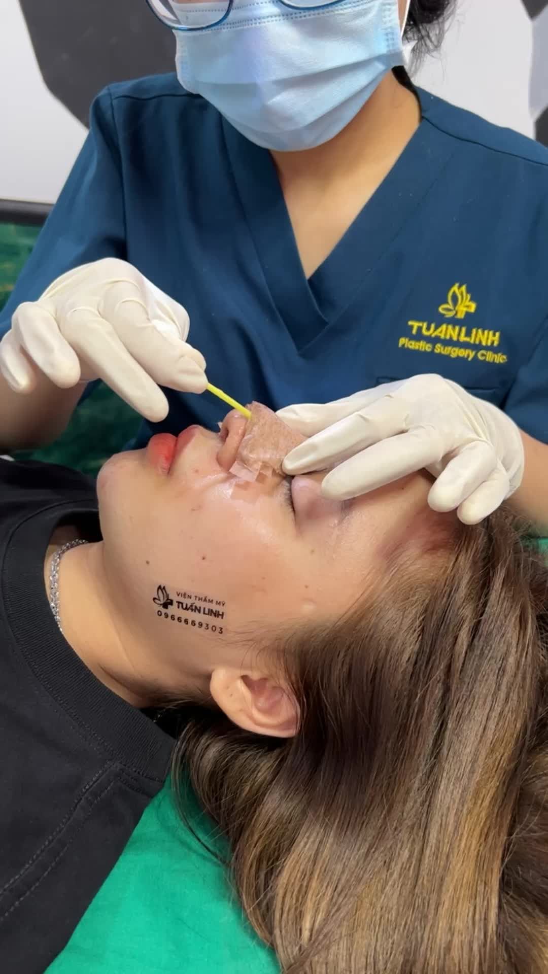 Case Tái khám sau 10 ngày nâng mũi cấu trúc.