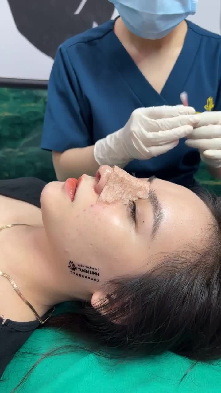 Khách xinh khoe mũi xinh sau 10 ngày tháo nẹp