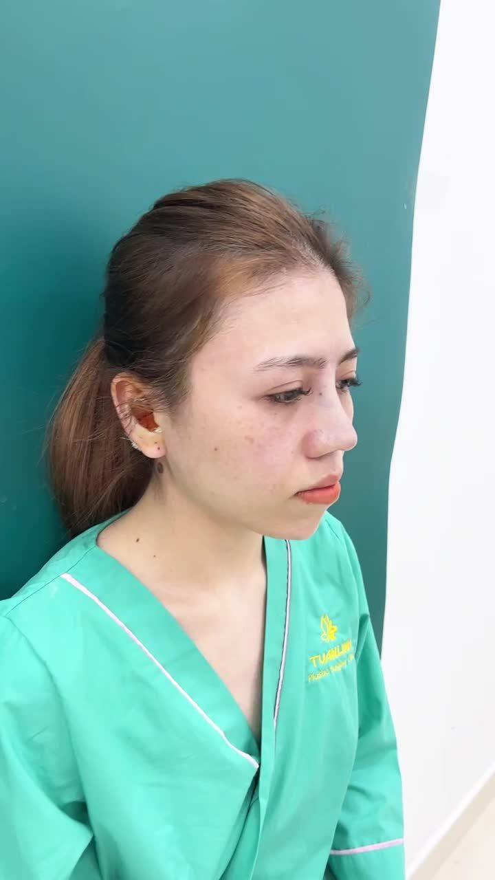 Case nâng mũi bán cấu trúc vừa hoàn thành sau 90 tại Tuấn Linh.