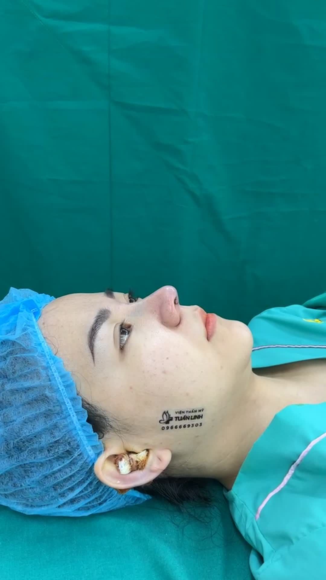 Trẻ hơn, sang hơn sau 90 phút Nâng mũi siêu cấu trúc