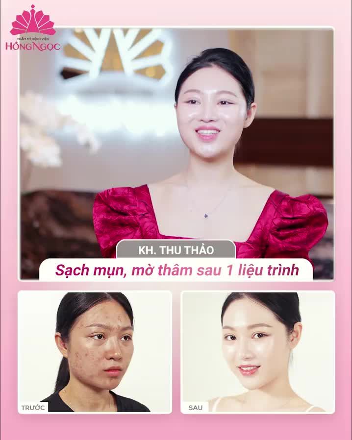 KHÁCH HÀNG NÓI GÌ SAU KHI ĐIỀU TRỊ MỤN TẠI HỒNG NGỌC