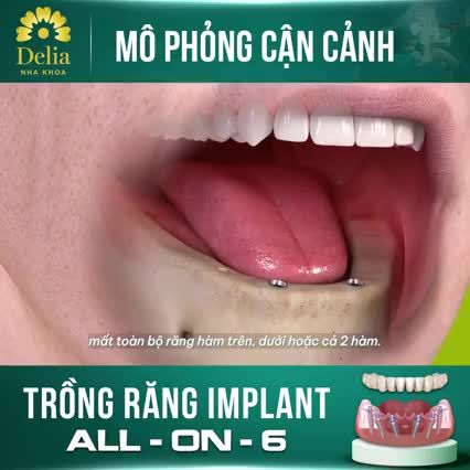 Kỹ thuật cấy Implant All On 6 diễn ra như thế nào
