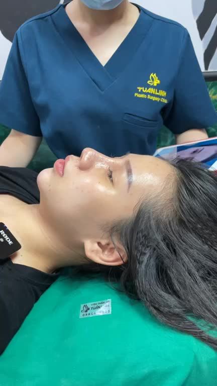 Ca nâng mũi bán cấu trúc sau 10 ngày tại vtm Tuấn Linh