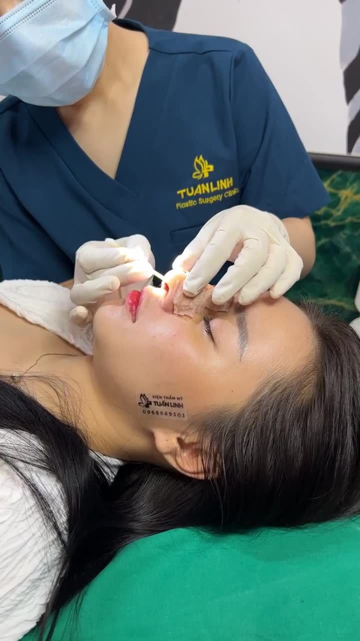Case nâng mũi Siêu cấu trúc sụn Surgiform tái khám, cắt chỉ sau 10 ngày
