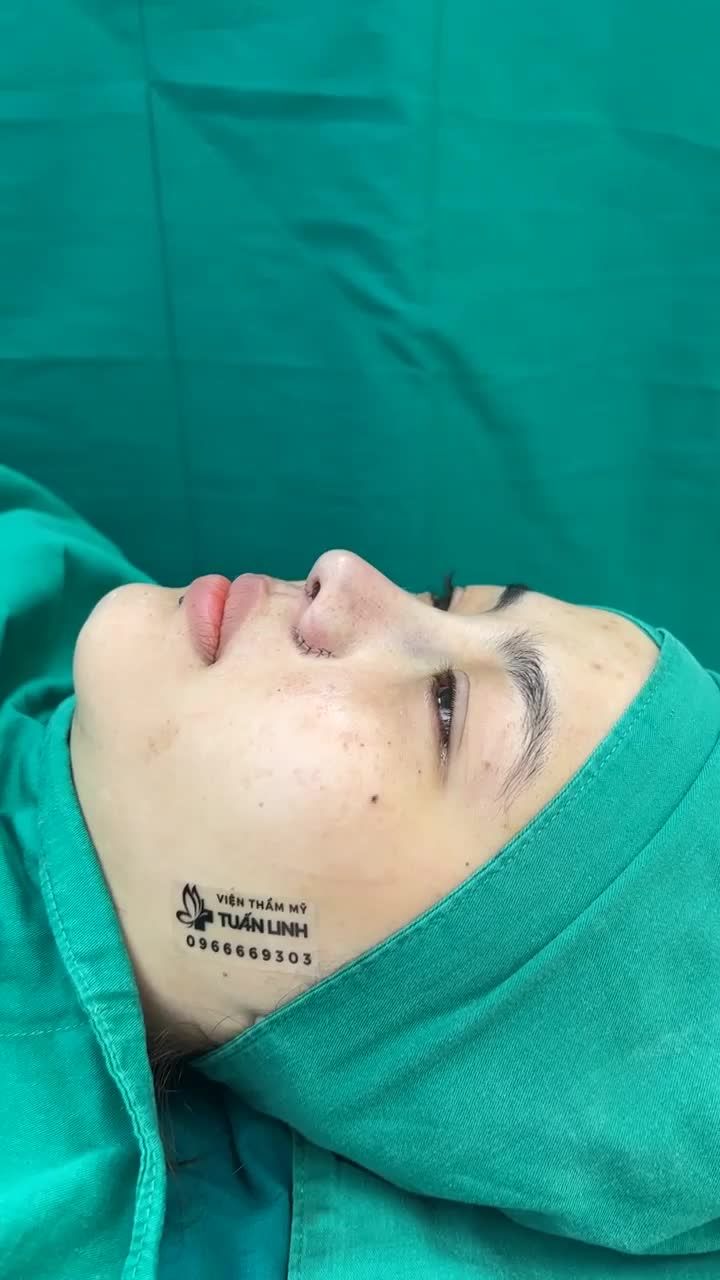 Case mũi Siêu cấu trúc + cuộn cánh lên dáng nhẹ nhàng cho bạn gái thích tự nhiên