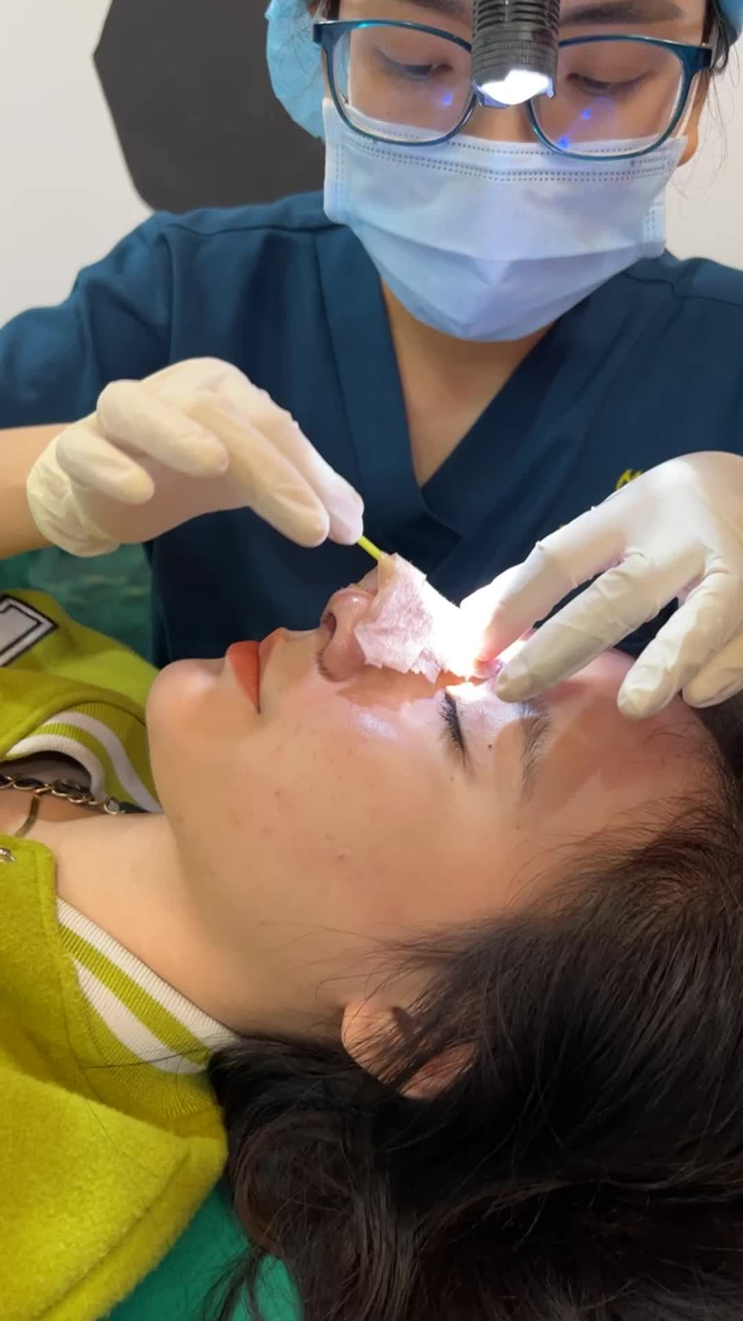 Case mũi Siêu cấu trúc sụn surgiform + cuộn cánh được 5 ngày