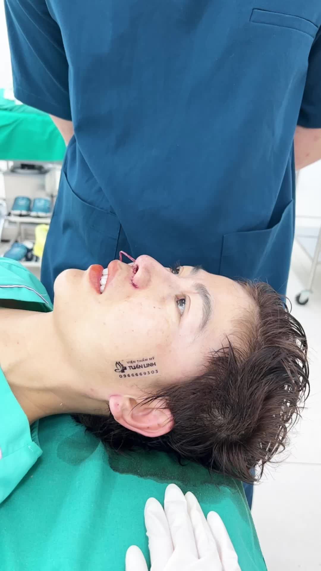 Case Nâng mũi siêu cấu trúc tặng sụn Surgiform + độn thái dương của chị gái đến từ Gia Lai!!!