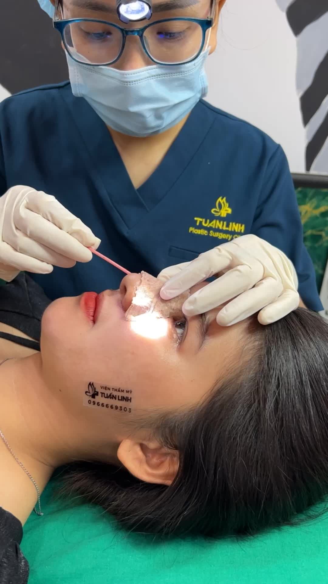 Đẹp xuất sắc sau 5 ngày nâng mũi Siêu cấu trúc + sụn surgiform + cắt cánh cho cô gái đến từ Bến Tre