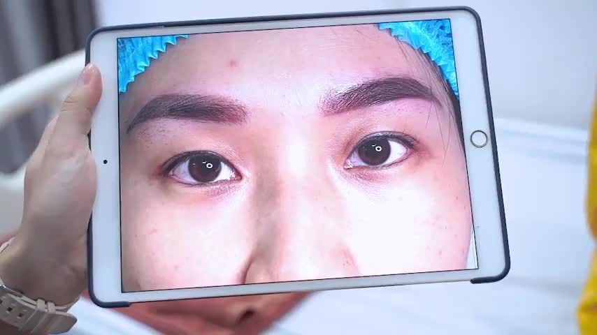 Mắt sụp mí, mí nhỏ u buồn được Bác sĩ tại Dr.Hải Lê HCM khắc phục như thế nào